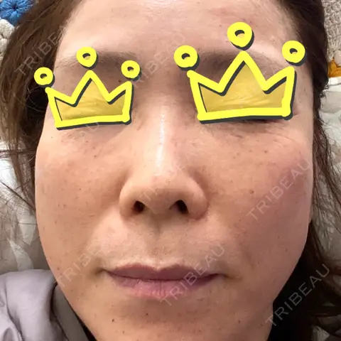 水光注射（ハリ・美肌） / その他（輪郭） ARTE SKIN CLINIC 【アルテスキンクリニック】 DAY 45