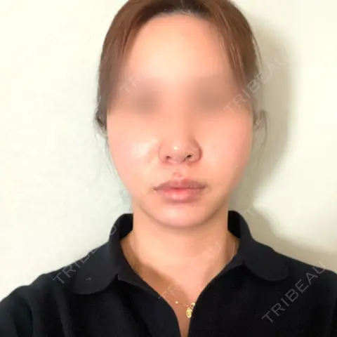 糸リフト / ヒアルロン酸注入（鼻） / ヒアルロン酸注入（あご） 銀座みゆき通り美容外科 大阪梅田院 DAY 0