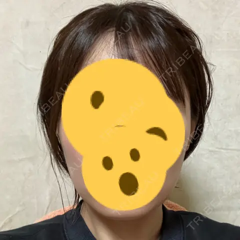 ボトックス（エラ・小顔） KARIS beauty clinic AFTER