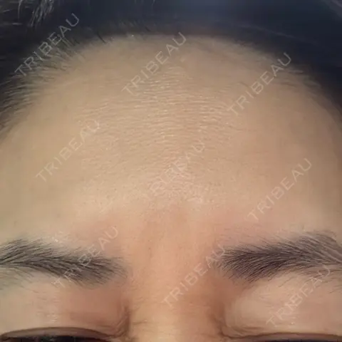 ボトックス（眉間） ちぐさ内科クリニック 覚王山 AFTER