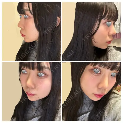 隆鼻術 / 鼻中隔延長（切開） / 軟骨移植 / 骨切幅寄せ / 眉間プロテーゼ / 自然癒着法 / その他（目元） LUHO（ルホ）美容外科 AFTER