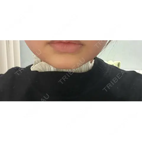 その他（肌） ルラ美容クリニック 仙台院 DAY 0