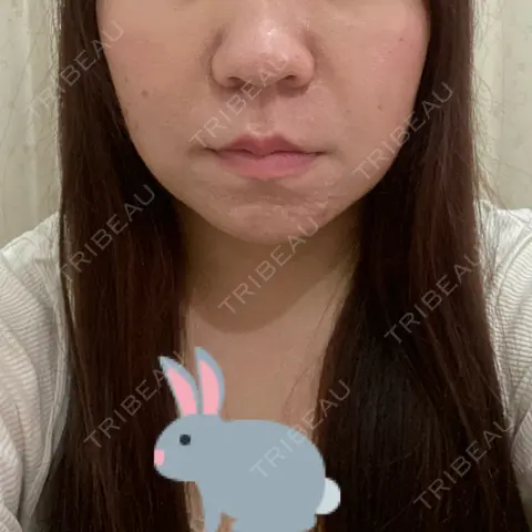 脂肪吸引（顔） / 脂肪吸引注射（顔） ziz CLINIC AFTER