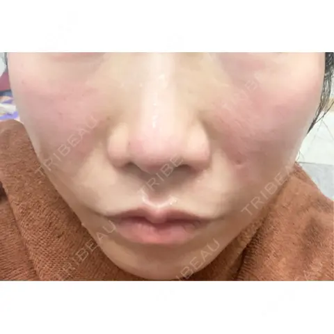 ボトックス（エラ・小顔） / ヴェルヴェットスキン おおたかの森ビューティークリニック DAY 0