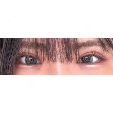 二重切開 / 眼瞼下垂（切開） オーキッド美容クリニック東京御徒町 AFTER