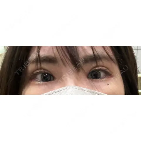 二重切開 / 眼瞼下垂（切開） オーキッド美容クリニック東京御徒町 AFTER