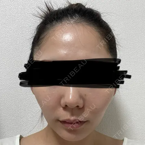 糸リフト / 脂肪吸引（顔） / メーラーファット除去 / ジョールファット除去 RIVER CLINIC（リバークリニック） AFTER