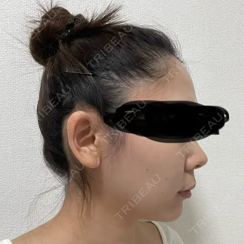 糸リフト / 脂肪吸引（顔） / メーラーファット除去 / ジョールファット除去 RIVER CLINIC（リバークリニック） AFTER