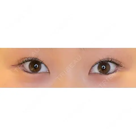 目尻切開 / タレ目形成・グラマラスライン（埋没） LOUIS CLINIC 二子玉川院【ルイクリニック】 AFTER