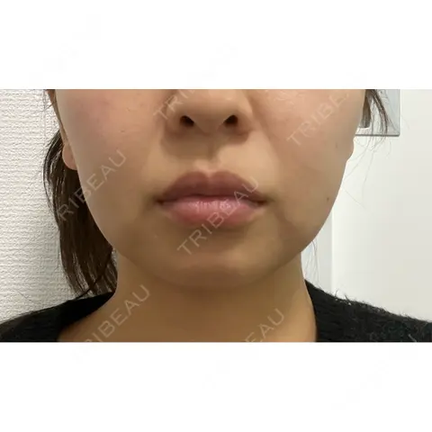 RF（高周波）たるみ治療 BISIN GINZA CLINIC DAY 0