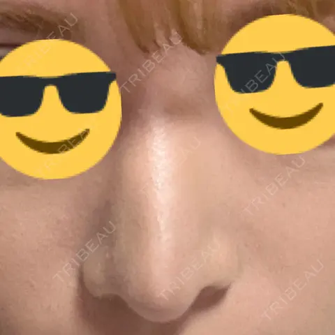 鼻尖形成（切開） / 軟骨移植 / 骨切幅寄せ / プロテーゼ除去 9BeautyClinic AFTER