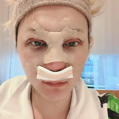 二重切開 / 目頭切開 / 眼瞼下垂（切開） / 隆鼻術 / 鼻中隔延長（切開） / 小鼻縮小（切開） / 骨切幅寄せ id（アイディ）美容外科 DAY 0