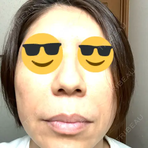 マイクロボトックス ルラ美容クリニック 千葉院 AFTER