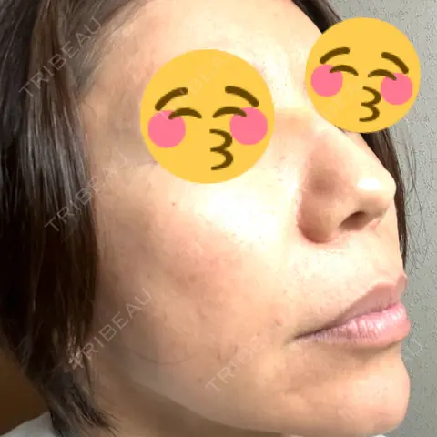 マイクロボトックス ルラ美容クリニック 千葉院 AFTER