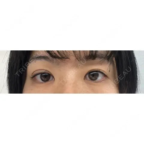 二重埋没 Shion Beauty Clinic DAY 0