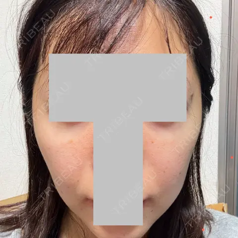RF（高周波）たるみ治療 LUNA BEAUTY CLINIC 池袋駅前院 AFTER