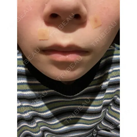 ほくろ・いぼ除去レーザー（肌） Mavie Beauty Clinic （マヴィービューティークリニック） DAY 1