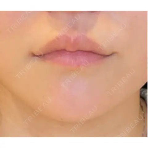 口角挙上 LOUIS CLINIC 二子玉川院【ルイクリニック】 AFTER