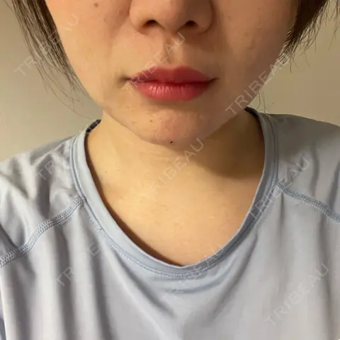 RF（高周波）たるみ治療 RIVER CLINIC（リバークリニック） AFTER