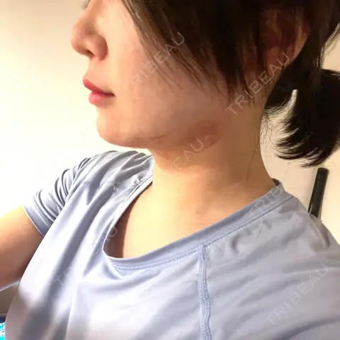 RF（高周波）たるみ治療 RIVER CLINIC（リバークリニック） AFTER