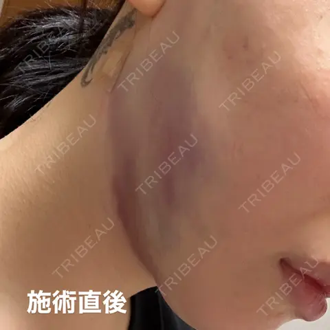 糸リフト / 脂肪吸引（顔） RIVER CLINIC（リバークリニック） DAY 1