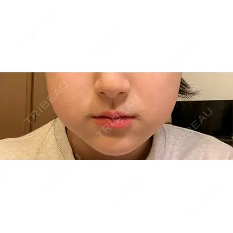 RF（高周波）たるみ治療 BISIN GINZA CLINIC AFTER