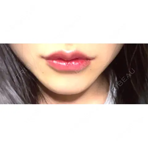 ヒアルロン酸注入（唇） おおたかの森ビューティークリニック AFTER