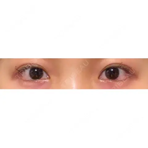 目尻切開 / タレ目形成・グラマラスライン（埋没） / ボトックス（エラ・小顔） LOUIS CLINIC 二子玉川院【ルイクリニック】 AFTER