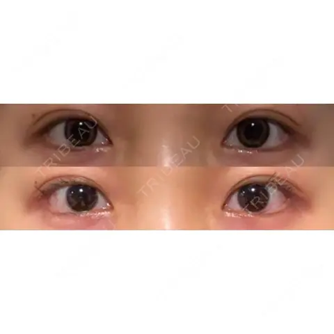 目尻切開 / タレ目形成・グラマラスライン（埋没） / ボトックス（エラ・小顔） LOUIS CLINIC 二子玉川院【ルイクリニック】 AFTER
