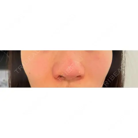 脂肪溶解注射（顔） ロレシー美容クリニック 心斎橋駅前院 DAY 0