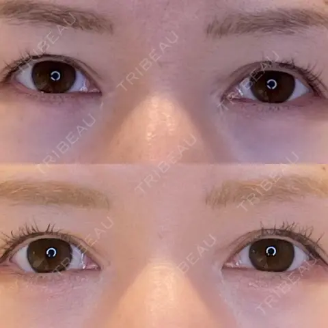 目尻切開 / タレ目形成・グラマラスライン（埋没） LOUIS CLINIC 二子玉川院【ルイクリニック】 AFTER