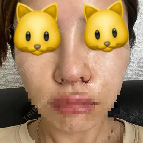 隆鼻術 / 鼻尖形成（切開） / 小鼻縮小（切開） / 軟骨移植 CLINIC W AFTER