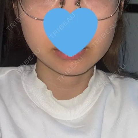 RF（高周波）たるみ治療 LUNA BEAUTY CLINIC 池袋駅前院 DAY 3