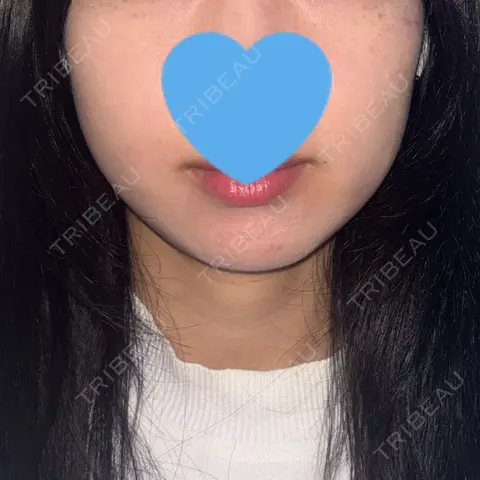 RF（高周波）たるみ治療 LUNA BEAUTY CLINIC 池袋駅前院 AFTER