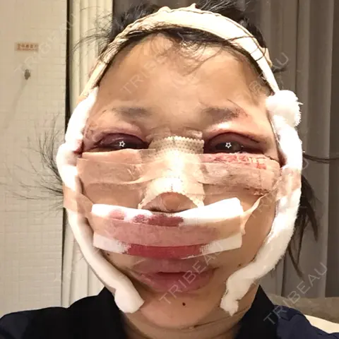 バッカルファット除去 / 額を丸く / 脂肪注入（額） / 切開リフト / ボトックス（エラ・小顔） / 脂肪注入（輪郭） ミナ美容外科 DAY 0
