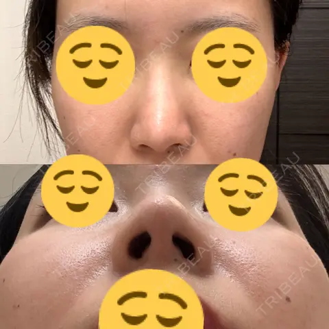 鼻尖形成（切開） / 鼻中隔延長（切開） / 糸リフト / 軟骨移植 / 鼻尖縮小 グローバルビューティークリニック 大阪院 AFTER