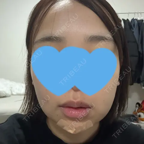 脂肪吸引（顔） / ボトックス（エラ・小顔） Mods Clinic（モッズクリニック） 東京院 DAY 1