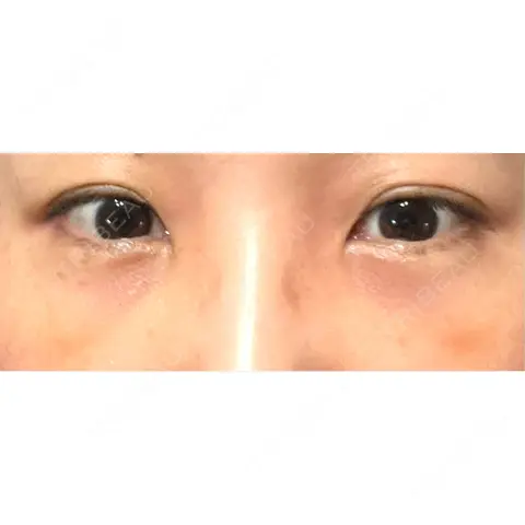 クマ治療 / 下まぶたの脂肪取り 東京BELLEZZAクリニック AFTER