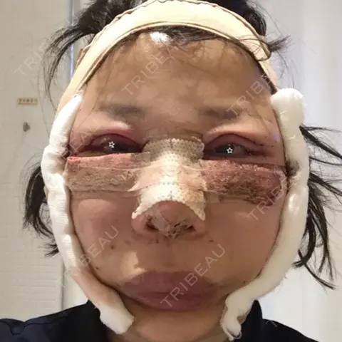 隆鼻術 / 鼻尖形成（切開） / 鼻中隔延長（切開） / 骨切幅寄せ / ワシ鼻修正・ハンプ切除 / ヒアルロン酸溶解 ミナ美容外科 DAY 2