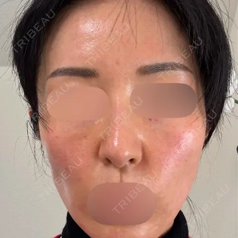 水光注射（ハリ・美肌） / リジュラン DAILY SKIN CLINIC 新宿院 DAY 0