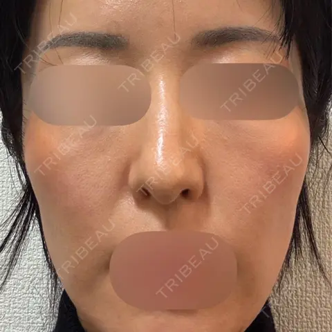 水光注射（ハリ・美肌） / リジュラン DAILY SKIN CLINIC 新宿院 AFTER