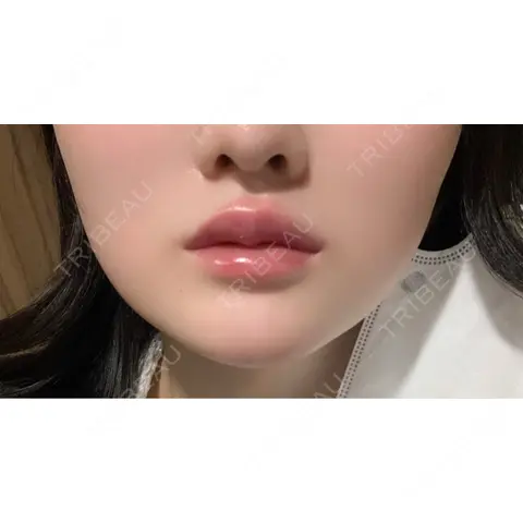 ボトックス（エラ・小顔） / ヒアルロン酸注入（唇） / ボトックス（口角） / ボトックス（人中） L‘amour clinic Tokyo【ラムールクリニック東京】 DAY 0
