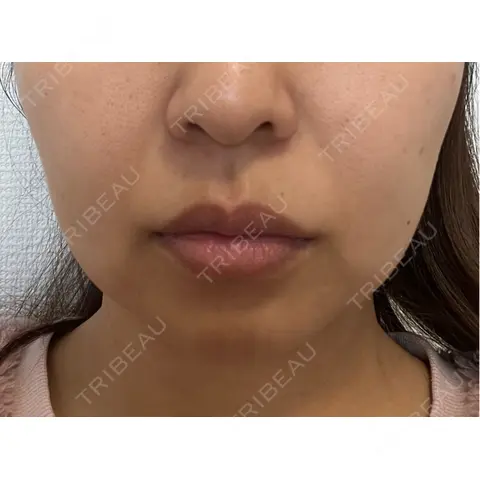 RF（高周波）たるみ治療 BISIN GINZA CLINIC AFTER