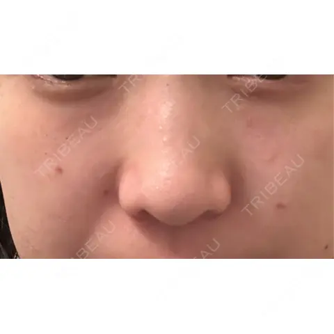 ほくろ・いぼ除去レーザー（肌） Fellez Clinic【フェルズクリニック】 AFTER
