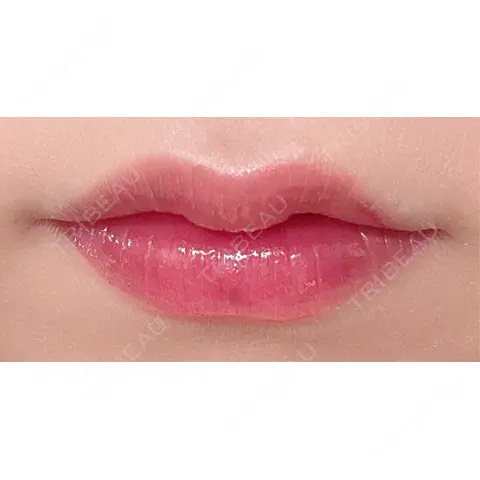 ヒアルロン酸注入（涙袋） / ヒアルロン酸注入（唇） EMMO FACE CLINIC 大阪梅田院 AFTER