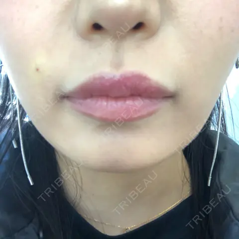 ヒアルロン酸注入（鼻翼基部） THE FIRST CLINIC 多摩センター院 AFTER