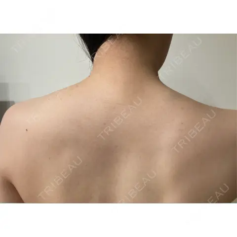 ボトックス（肩） ちぐさ内科クリニック 覚王山 AFTER