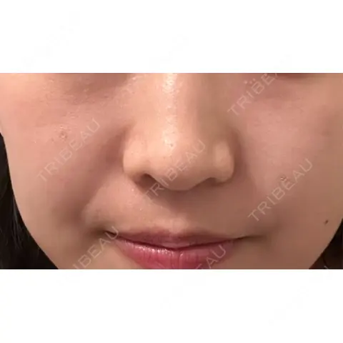 ほくろ・いぼ除去レーザー（肌） Fellez Clinic【フェルズクリニック】 AFTER