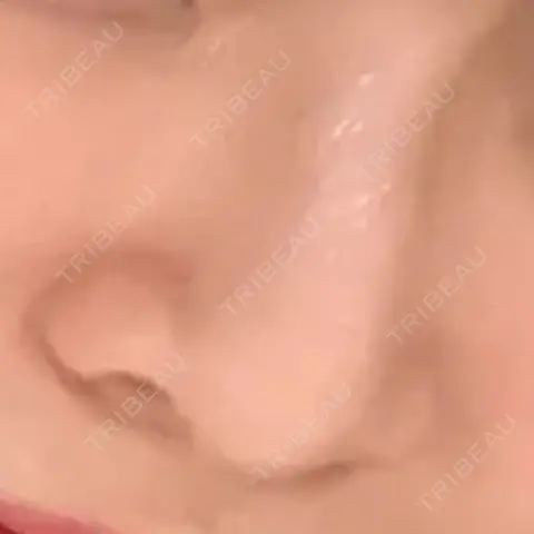 ヒアルロン酸注入（鼻） ziz CLINIC AFTER