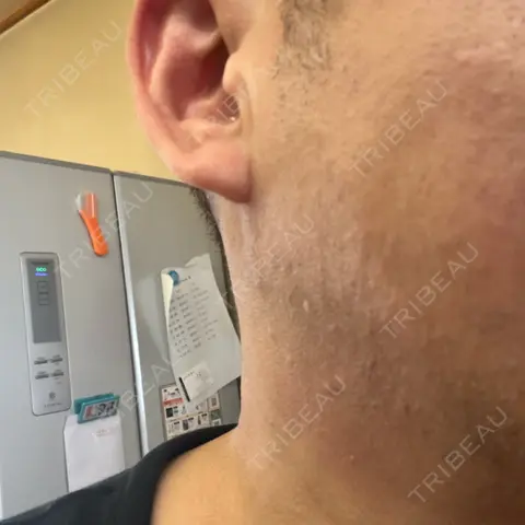 RF（高周波）たるみ治療 BISIN GINZA CLINIC AFTER